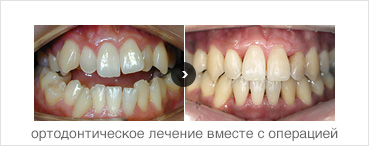 ортодонтическое лечение вместе с операцией